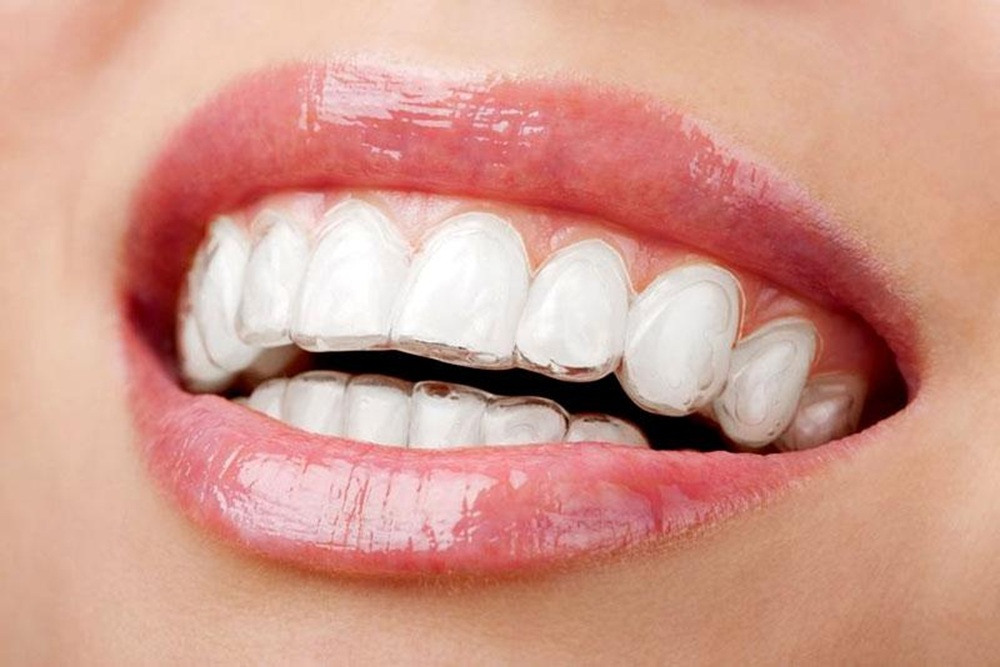 Intra Oral